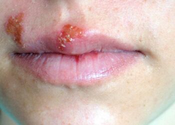 Oral Sores, Blisters Symptom Of Herpes, Not Malaria – Microbiologist