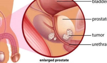 Sexual Intercourse, Not Masturbation Could Help Prevent Prostate Cancer – Expert