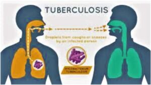 TUBERCULOSIS 