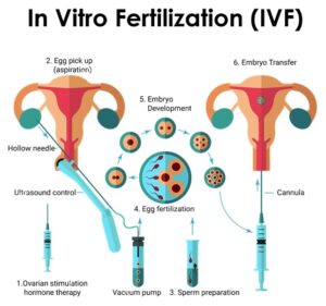 IVF