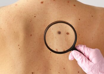 Patients Exhibited Later Stage Melanoma During COVID-19 Pandemic – Study