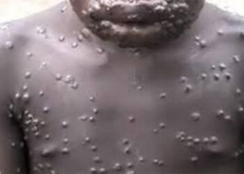 What You Need To Know About Monkeypox
