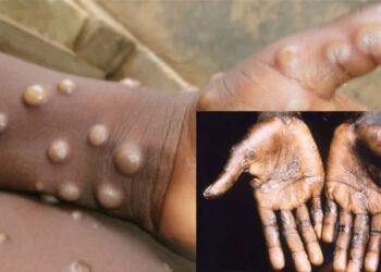 Red Alert: Monkeypox Spreads To 15 States, Cases Now 36 – NCDC
