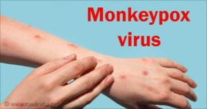 Monkeypox-virus