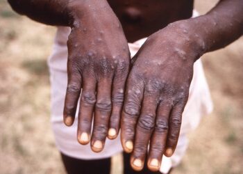 Panic As Monkeypox Spreads To 32 States, Cases Now 604