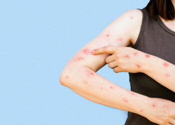 Study Suggests Monkeypox Spreads Four Days Before Symptoms Appear