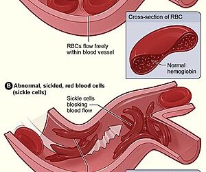 REAL LIFE EXPERIENCE:  Making Progress Despite Sickle Cell: My Story