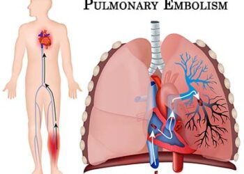 Pulmonary Embolism: Black Men Are More At Risk Of Blood Clots In The Lung