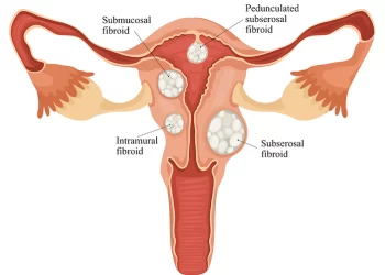 The ‘Ordeal’ Called Fibroid