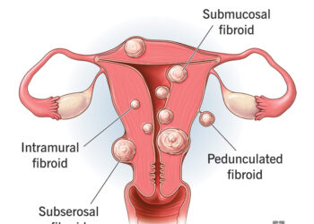 The ‘Ordeal’ Called Fibroid