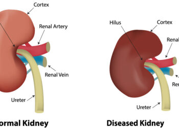 World Kidney Day: Expert Urges Healthy Lifestyle to Prevent Kidney Disease