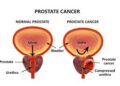 Frequent Ejaculation May Lower Prostate Cancer Risk- Expert