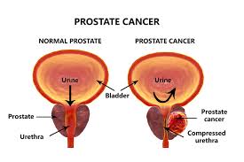 Frequent Ejaculation May Lower Prostate Cancer Risk- Expert