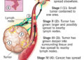 WHO Says 4 In 10 Cancer Cases Preventable