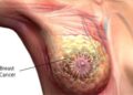 Experts, Survivor Harp On Early Detection To Enhance Cancer Treatment