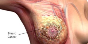 Experts, Survivor Harp On Early Detection To Enhance Cancer Treatment
