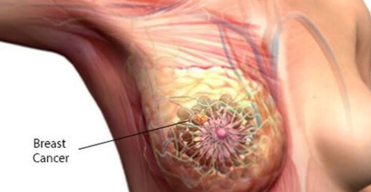 Experts, Survivor Harp On Early Detection To Enhance Cancer Treatment