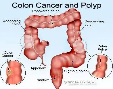 Early Screening, Healthy Diet Key To Fighting Colon Cancer—Oncologist